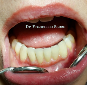 Implantologia Dentale Dr. Francesco Sacco